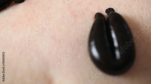 the procedure hirudotherapy, leech therapy