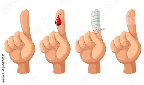 Finger with cut and bandages