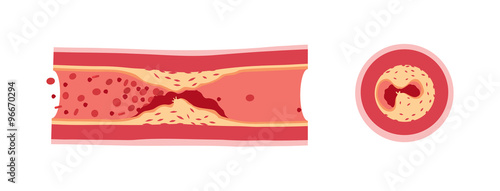 Atherotrombosis in vessels
