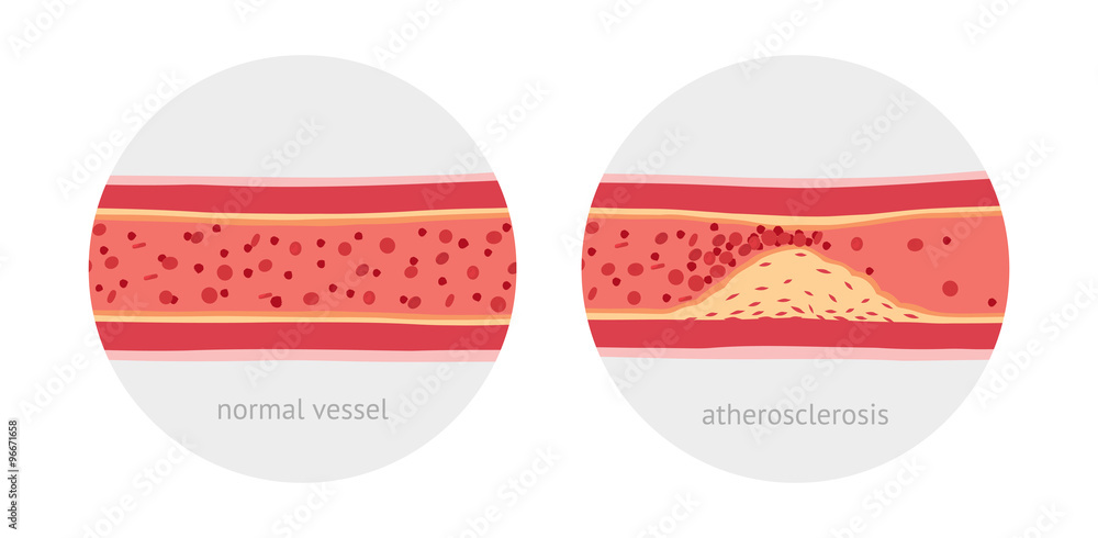 Healthy and atherosclerosis vessels with blood cells vector ...