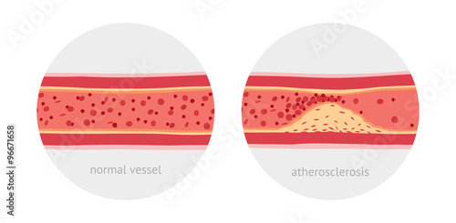 Healthy and atherosclerosis vessels with blood cells vector illustration