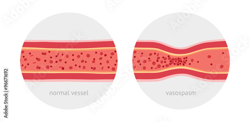 Healthy and sick spasm anatomical vessels with blood cells vector illustration