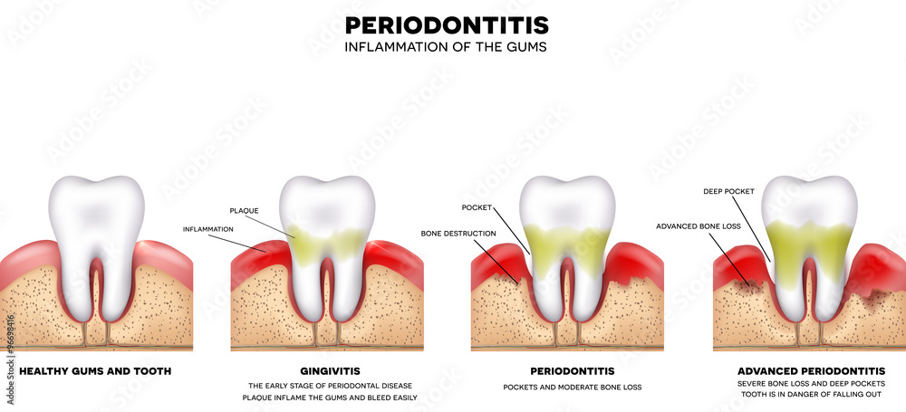 Fototapeta premium Periodontitis, inflammation of the gums, detailed illustration