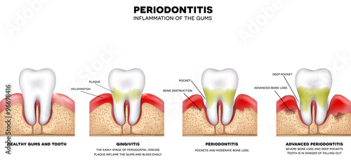 Periodontitis, inflammation of the gums, detailed illustration