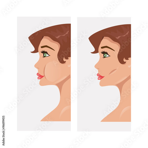 Plastic cheekbones. Vector Illustration