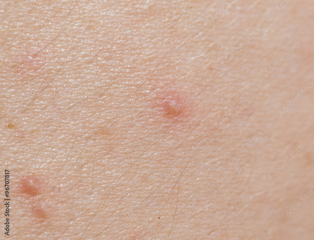 pimples on the skin. close pimples on the skin. close