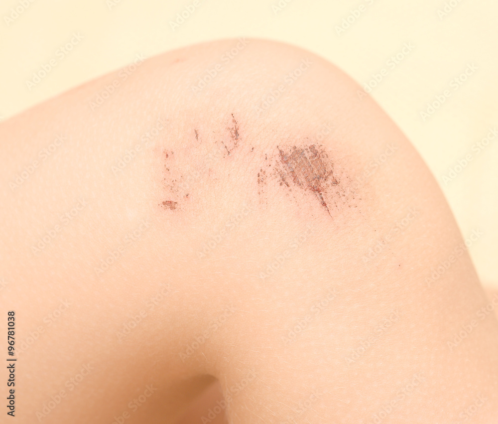 Fototapeta premium scraped knees