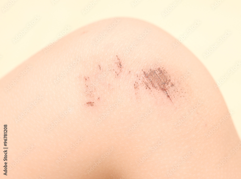 Fototapeta premium scraped knees