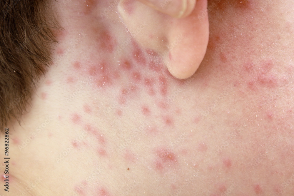 Fototapeta premium detail of chicken pox effects