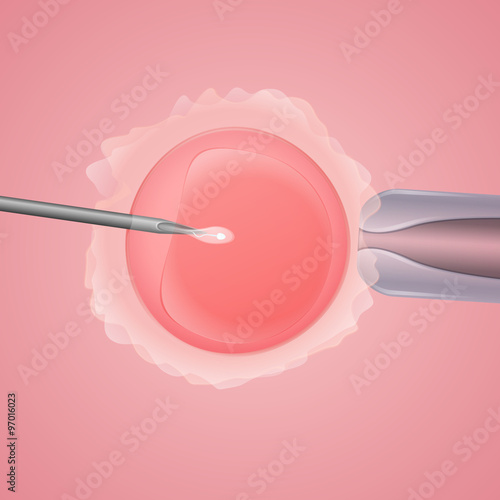 in vitro fertilization