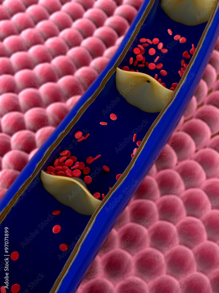 artery with a fatty plaques and erythrocytes, Contraction of blood