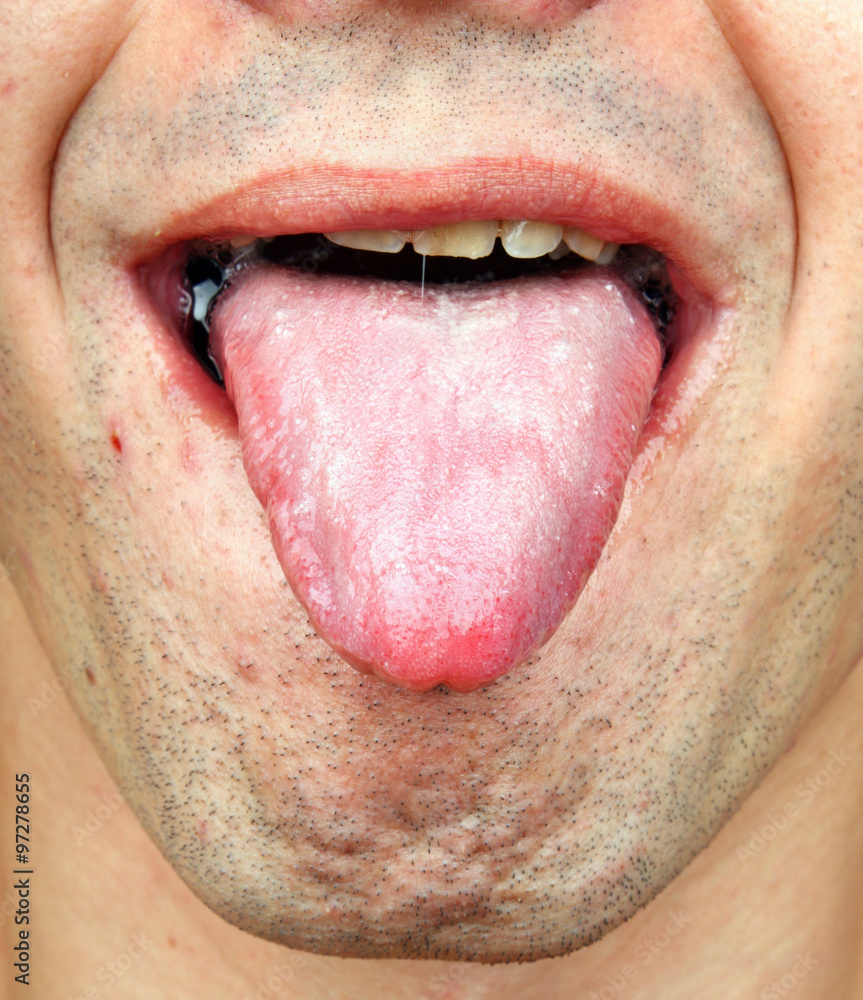 Obraz premium Bacterial infection tongue