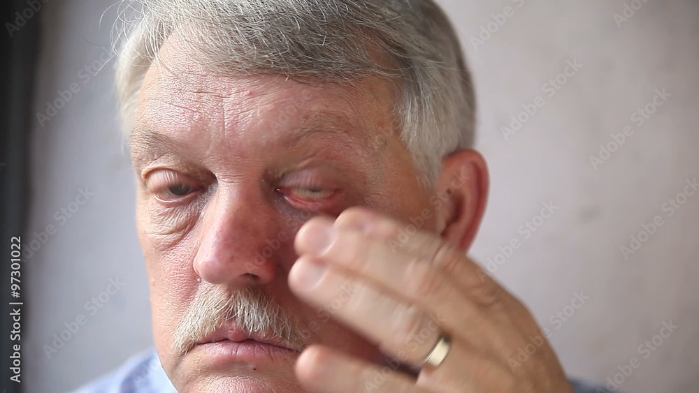 An older man pulls down a lower lid for a better look at his strained eye. An older man pulls down a lower lid for a better look at his strained eye.