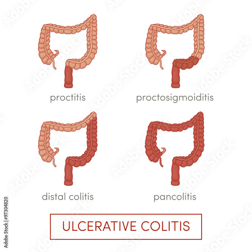 Ulcerative colitis vector photo