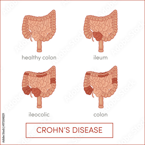Crohn's disease vector