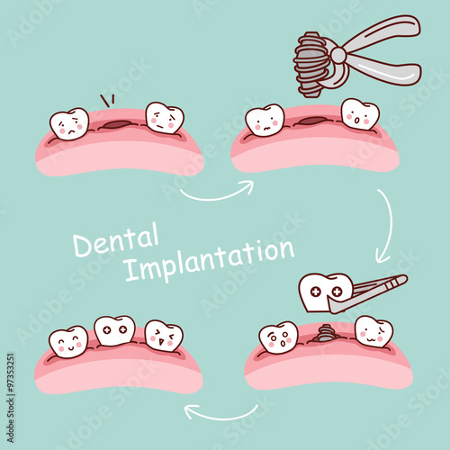cartoon tooth dental implantation concept