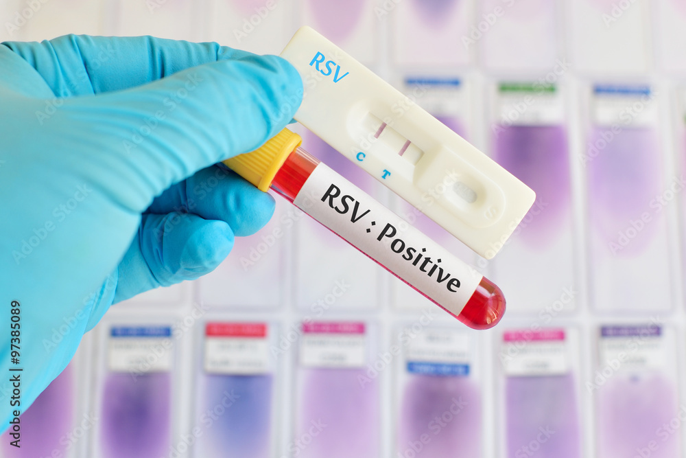 Respiratory syncytial virus (RSV) testing positive Respiratory syncytial virus (RSV) testing positive
