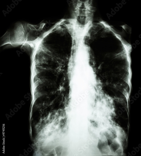 Pulmonary Tuberculosis  ( film chest x-ray :  interstitial infiltrate both lung due to Mycobacterium tuberculosis infection ) photo