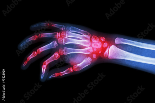 Rheumatoid arthritis , Gouty arthritis ( Film x-ray hand of child with arthritis at multiple joint )