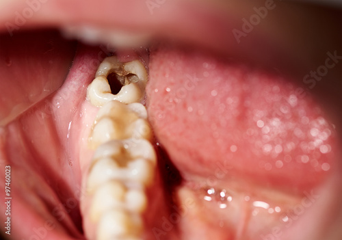 Obraz na plátně Damaged tooth with cavity dental caries decay