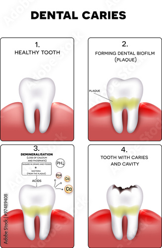 Dental caries formation, dental plaque, loss of calcium, phosphate and finally caries and cavity