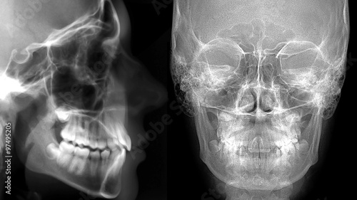 cefalometria: profilo frontale e laterale photo