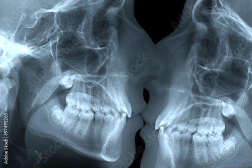 bacio radiografia dentale photo