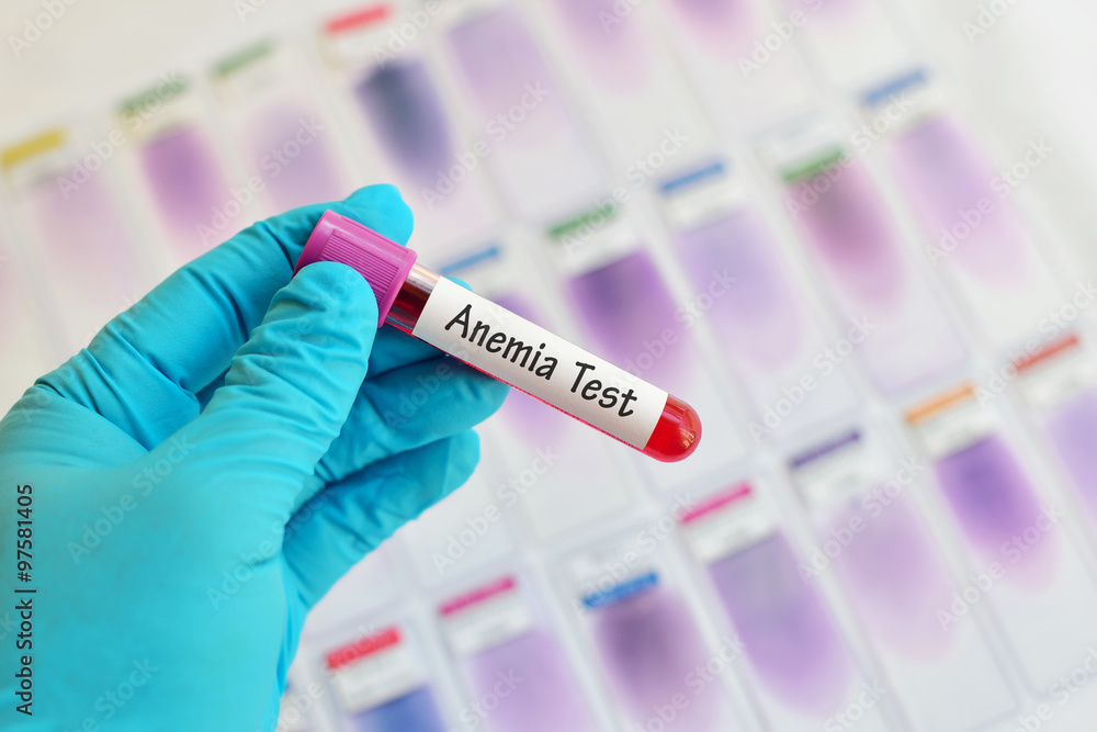 Blood sample for anemia test