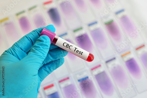 Tableau sur toile Blood sample for complete blood count (CBC) test