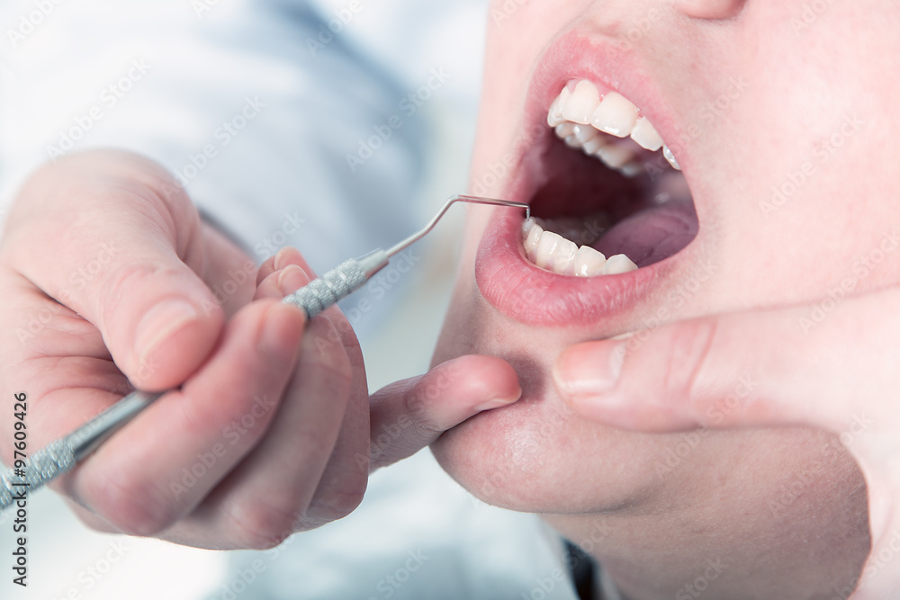 Obraz premium Close-up of patients open mouth during oral checkup with mirror near by