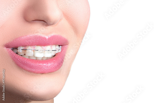 Closeup Ceramic Braces on Teeth. Beautiful Female Smile with Braces. Orthodontic Treatment. Dental care Concept. 