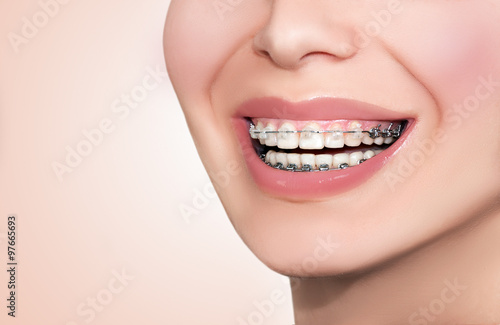 Ceramic Dental Braces Teeth. Closeup Female Smile.