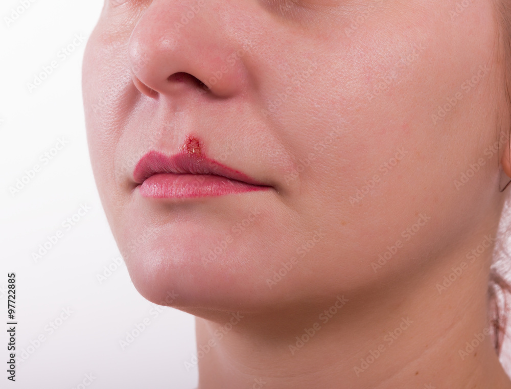 Obraz premium Girl lip diseased herpes. scabs on the stage of drying