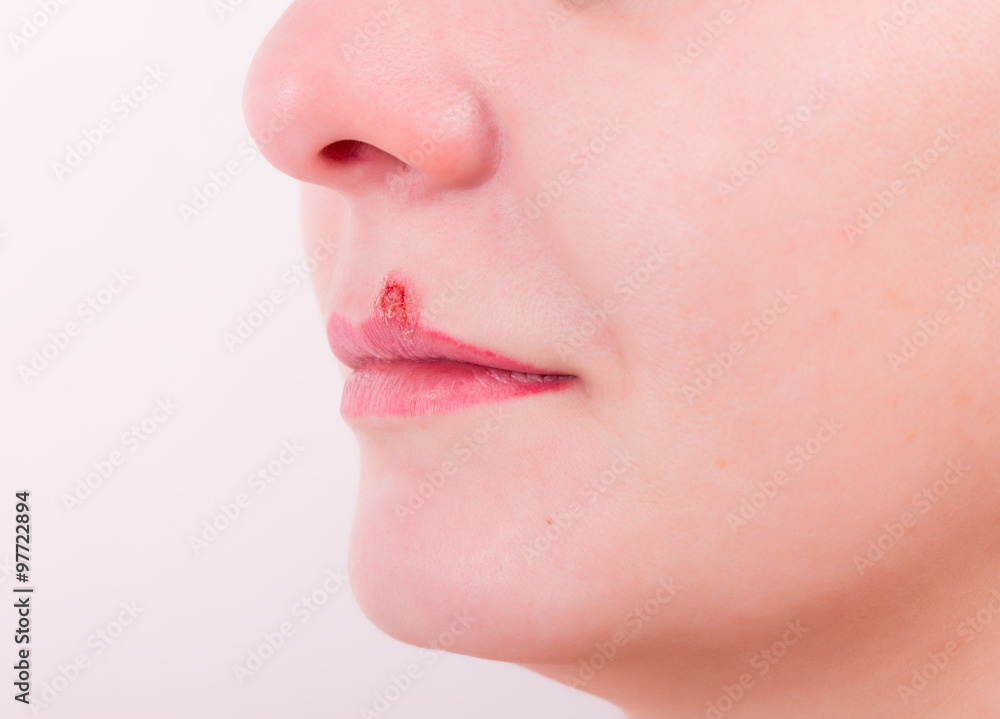 Obraz premium Girl lip diseased herpes. scabs on the stage of drying