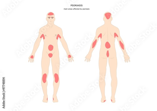 principali aree del corpo umano colpite dalla psoriasi