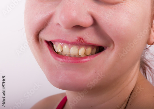 Girl lip diseased herpes. scabs on the stage of drying