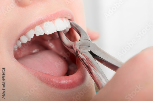 Fototapeta Naklejka Na Ścianę i Meble -  Removing the sick tooth from girls mouth