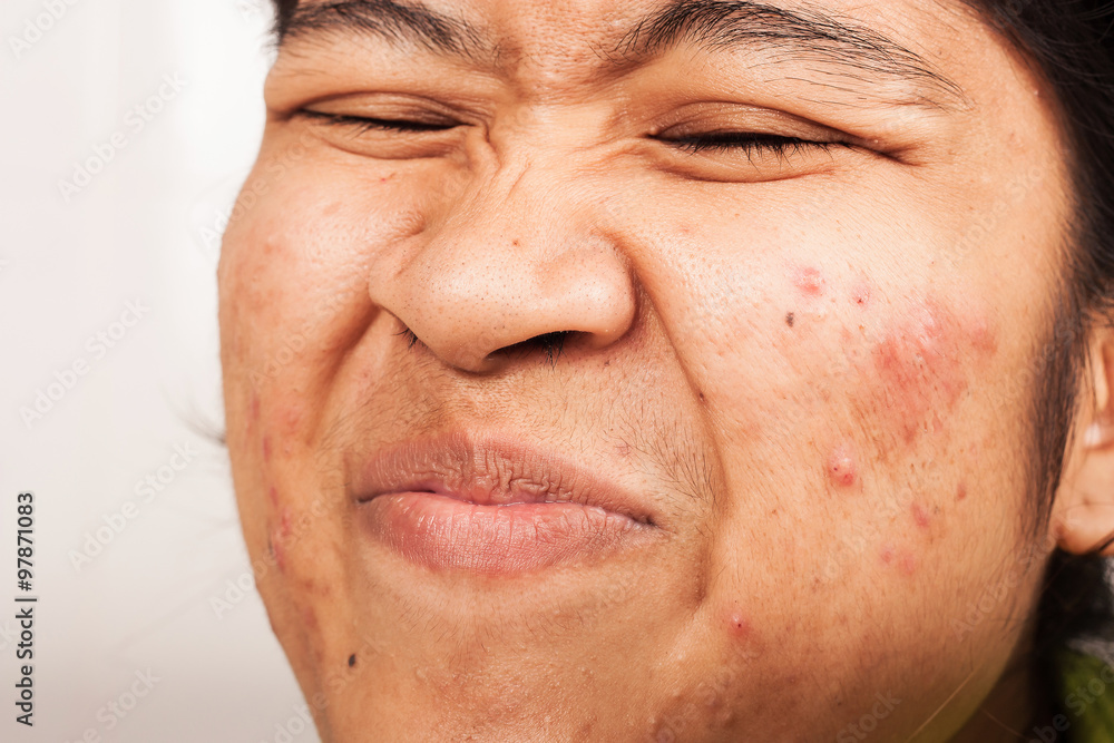 Naklejka premium women show hair at nose and acne on face