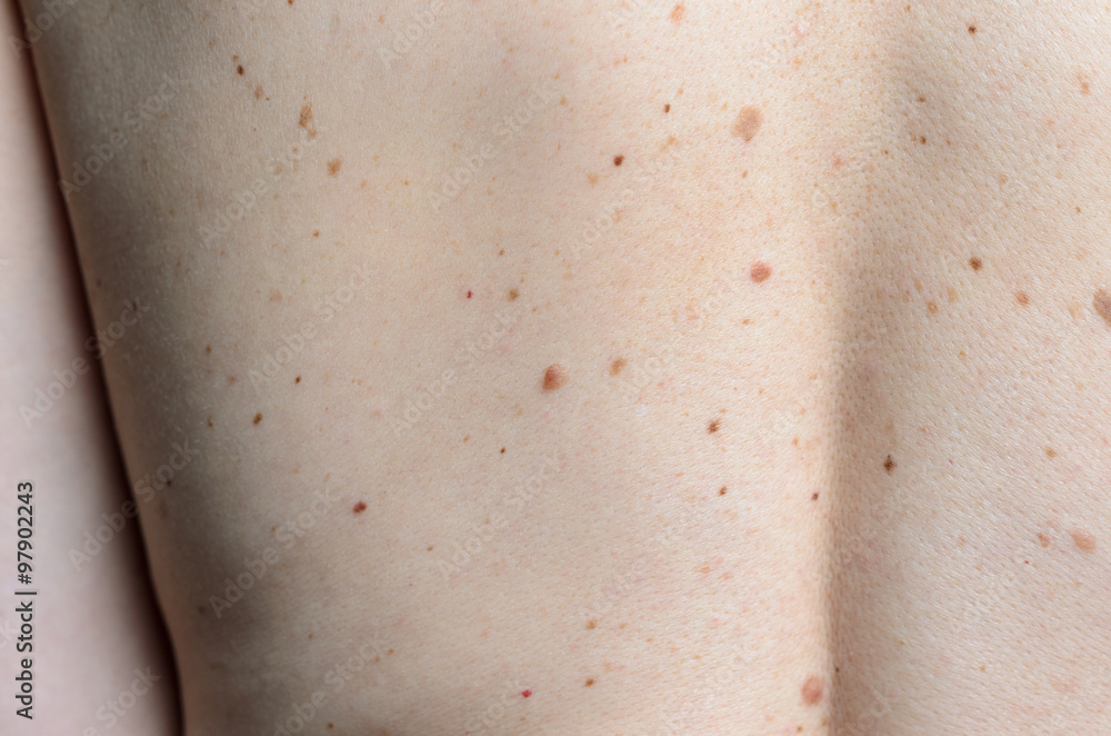 Skin on a womans back with moles Skin on a womans back with moles