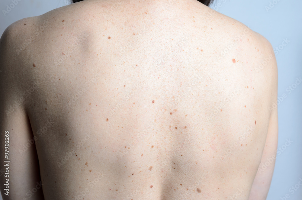 Skin on a womans back with moles Skin on a womans back with moles