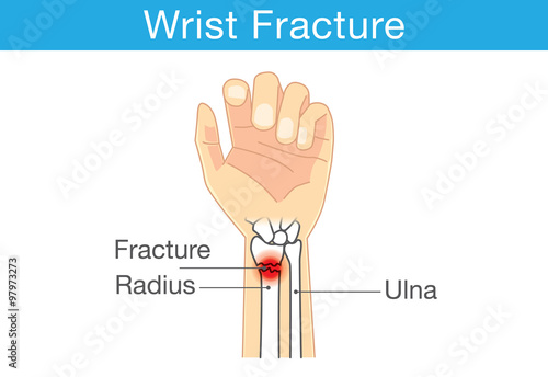 Fotografia Diagram of wrist have bone fracture