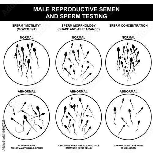 normal and abnormal sperm