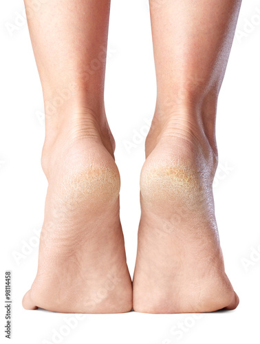 sore skin of feet, dry heels