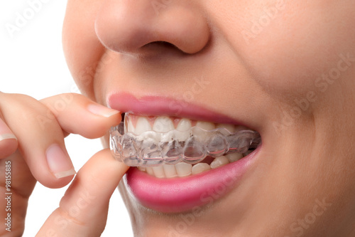 Woman wearing orthodontic silicone trainer photo