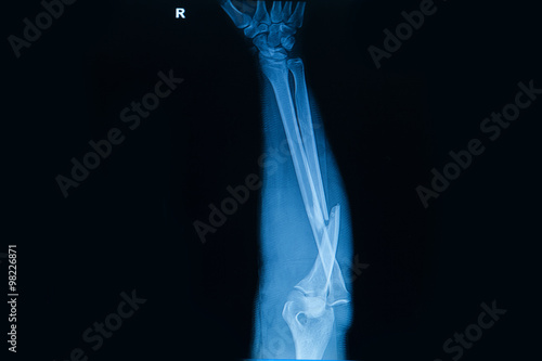 Fototapeta Collection of human x-rays  showing fracture  of  radius  bone