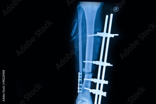  human x-rays , fracture of right leg post operated with external fixation 