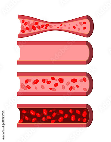 Anatomical human blood vessels set. Healthy blood vessel. Diseas