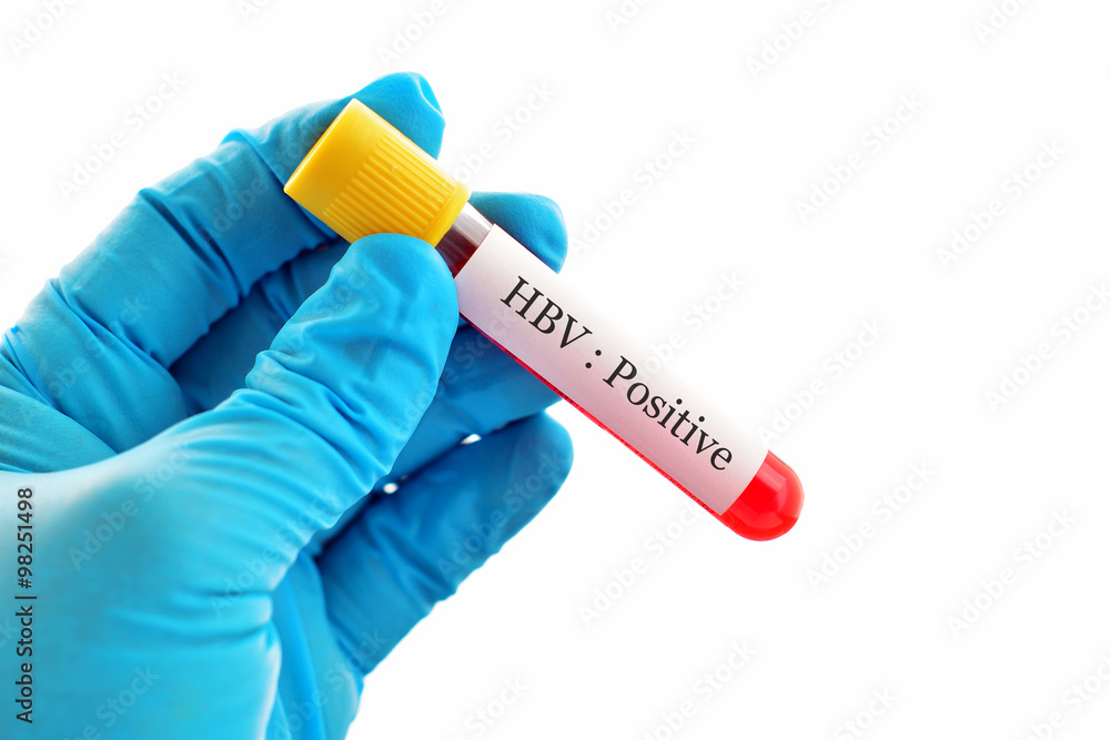 Obraz premium Blood sample with hepatitis B virus (HBV) positive