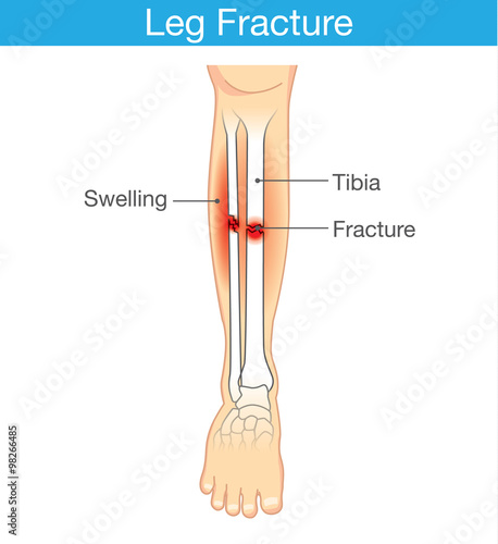 Diagram of leg have bone fracture. This illustration have description of inner leg composition.