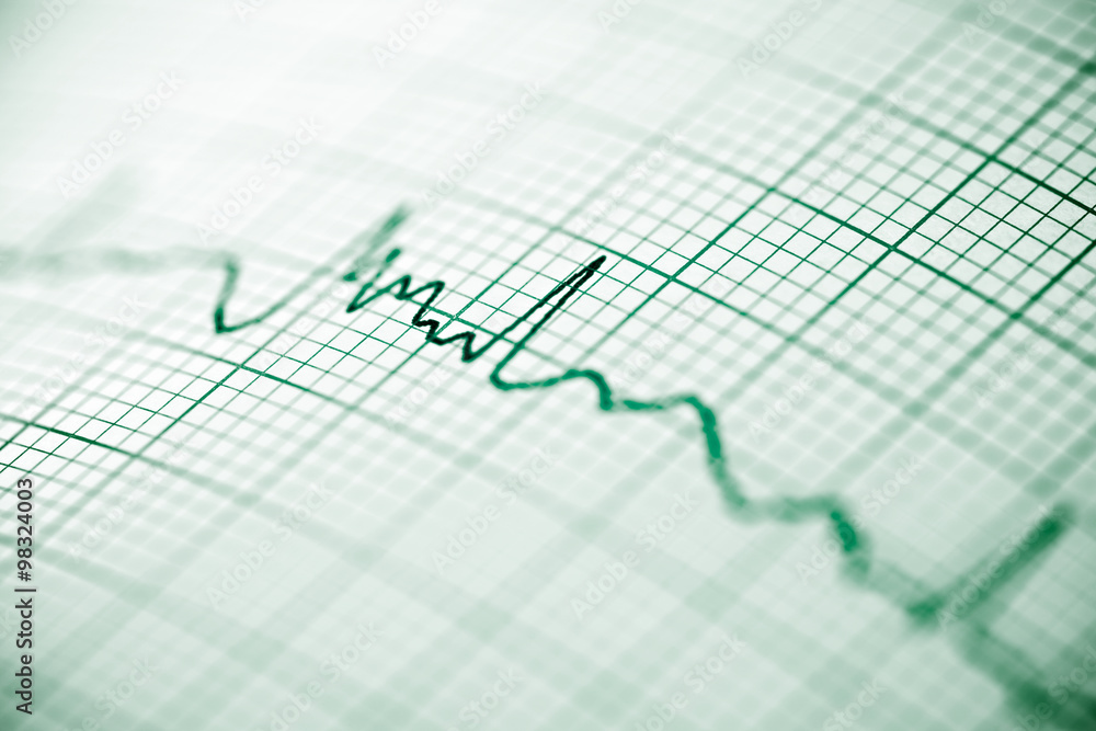 Electrocardiogram Electrocardiogram
